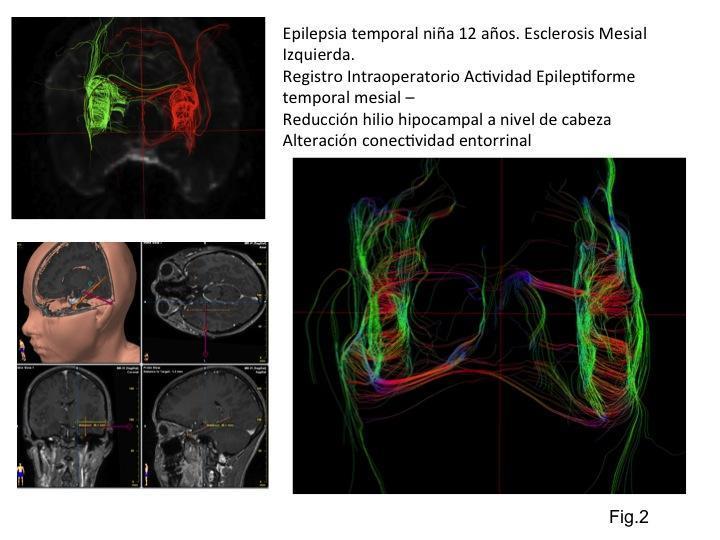 Esclerosis mesial en epilepsia temporal Esclerosis mesial en epilepsia temporal