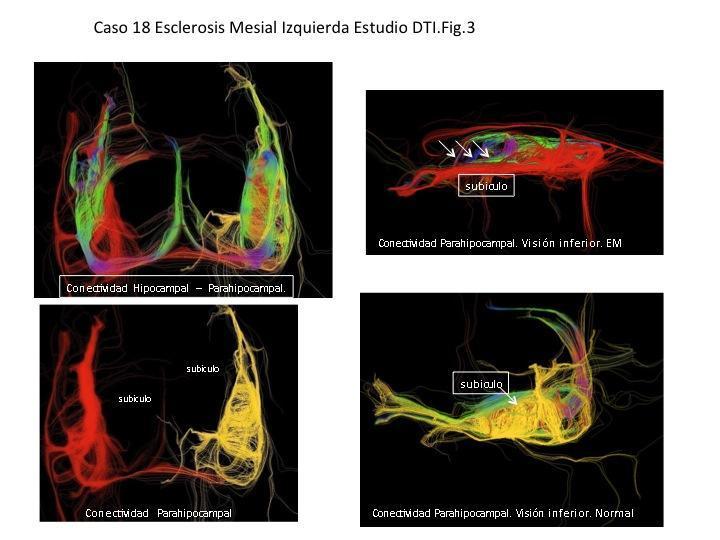 Esclerosis mesial izquierda Esclerosis mesial izquierda