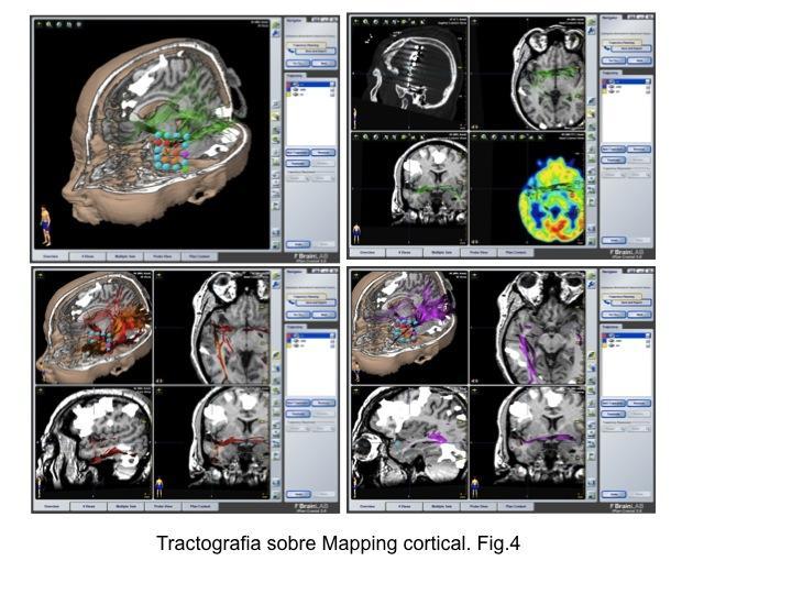 Tractografía sobre mapping cortical Tractografía sobre mapping cortical